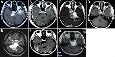 Surgical Treatment and Clinical Outcomes of Petroclival Meningiomas: A Single-Center Experience of 107 Patients